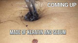 Navel Stone or Giant Belly Blackhead Bizarre Medical [upl. by Tiemroth]