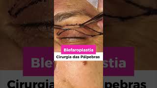 Assim é feita a Blefaroplastia [upl. by Mayap434]