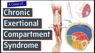 Chronic Exertional Compartment Syndrome [upl. by Ano]