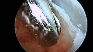 Posterior Arthroscopy with Haglunds Deformity Debridement SFISM [upl. by Yramliw]