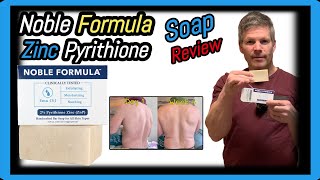 Noble Formula 2 Pyrithione Zinc Bar Soap Review With Before and After Images [upl. by Bendicty]