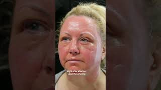 Laser Skin Resurfacing shortvideo shorts transformation [upl. by Cully]