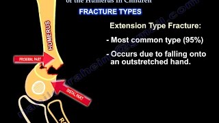 Supracondylar Fractures Of The Humerus In Children [upl. by Halladba]