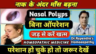 नाक के अंदर माँस बढ़ना। Nasal Polyps Treatment Without Surgery। Nasal Polyps Homeopathic Medicine। [upl. by Nurse]