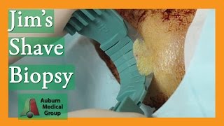 Jims Forehead Shave Biopsy for Basal Cell Carcinoma  Auburn Medical Group [upl. by Cavallaro]