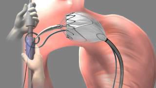 Thoracic Aortic Graft  Medical Animation by Watermark [upl. by Eveline609]