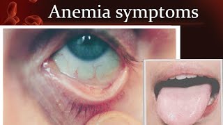 Anemia symptoms [upl. by Zamora]