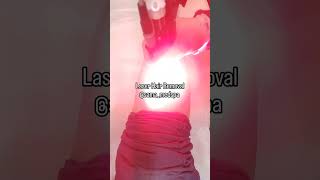 Laser Hair Removal  Not painful Permanent hair reduction Cynosure Elite plus for all skin types [upl. by Ahto864]