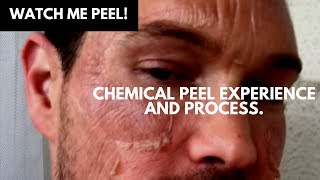 WATCH ME PEEL MY CHEMICAL PEEL EXPERIENCE AND PROCESS OF TCA ACID CHEMICAL PEEL [upl. by Adnilrev]