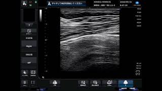 Transversus thoracic muscle plane block01 [upl. by Ayarahs190]