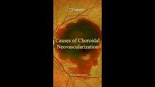 Causes of Choroidal Neovascularization maculardegeneration [upl. by Nyleaj]