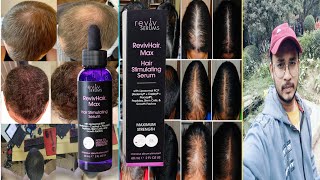 revivhair max hair stimulating serum  honest review [upl. by Anatolio]