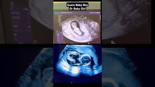 Guess Baby Boy Or baby Girl Gender Reveal Pregnancy Ultrasound V5 baby babyboy babygirl girl [upl. by Ardnauqal880]