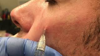 Acne Scar Correction with Volbella Dermal Filler  Dr David P Rapaport NYC [upl. by Farley]