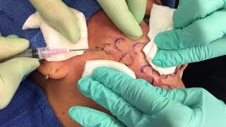 Subcision at Sanova Dermatology [upl. by Milford804]