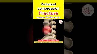 Vertebral compression fracture Treatment  Lumbar kyphoplasty shorts spinesurgery lumbarspine [upl. by Atnicaj]