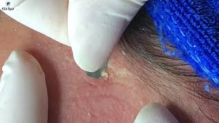 Hidden Acne in Ga Spa Hope u relax with this Video [upl. by Mccahill]