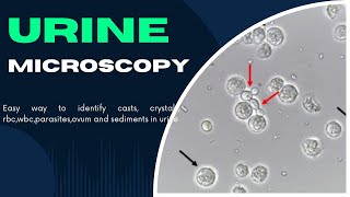 Complete Urine Microscopy Examination  How to identify CastsCrystalsRBCWBCParasiteOva in urine [upl. by Notreve561]