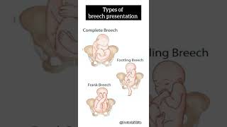 Types of breech presentation  viralvideo breech [upl. by Iand]