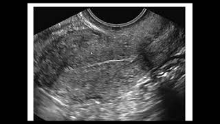 Assessment of endometrium by ultrasonography [upl. by Brooking]