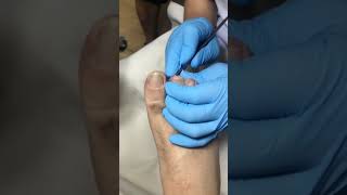 Ingrown toenail removal with Pedicure Knife Cut it easily Ep126 [upl. by Xanthe716]