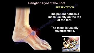 Foot and Ankle ganglion cyst  Everything You Need To Know  Dr Nabil Ebraheim [upl. by Tibbitts]