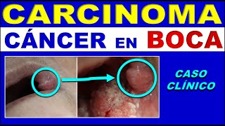 CARCINOMA EPIDERMOIDE EN CAVIDAD ORAL CÁNCER BUCAL DE CÉLULAS ESCAMOSAS [upl. by Anala]