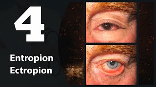 4 Eye lids Entropion amp Ectropion [upl. by Adnuahsal693]