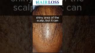 Types of Alopecia What is CCCA [upl. by Derej602]