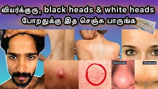 Summer Heat 🥵 Pimples Remady  Tips For Clear Skin  தமிழ் [upl. by Llerdnad]