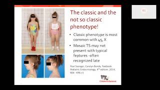 Turner syndrome Beyond the classic XO phenotype [upl. by Anu]