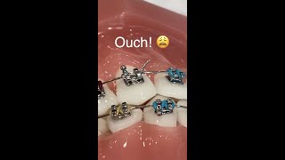 Braces Wire Poking Lips And IT HURTS SO BAD 😩 Orthodontist Reacts… [upl. by Eceela410]