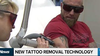 Erasing your ink new technology helps remove tattoos [upl. by Ahkos285]