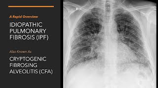 Idiopathic Pumonary Fibrosis  A Rapid Overview  Pathophysiology Diagnosis amp Management of IPF [upl. by Lau857]