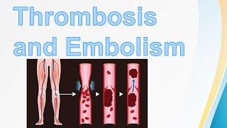 Thrombosis amp Embolism  Virchows triad  Pulmonary Embolism  Types of Embolus  Venous Thrombi [upl. by Haonam936]