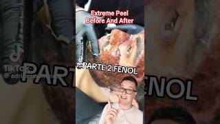 TW😱 SHOCKING CHEMICAL PEEL  Phenol Peel Before and After shorts [upl. by Mintz]