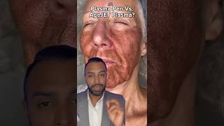 Plasma Fibroblast Vs AgeJet Plasma Which One Dr Somji Explains [upl. by Narba507]