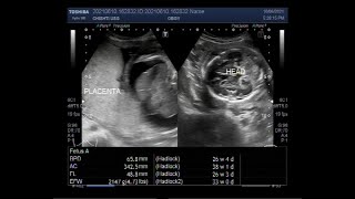 Hydrops fetalis with Soft tissue edema Cardiomegaly Pericardial effusion and ascites [upl. by Kyl887]