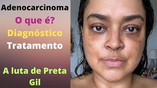 Adenocarcinoma o que é o câncer descoberto por Preta Gil sintomas e como é o diagnóstico [upl. by Ynoffit]