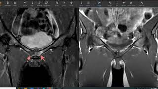 Pelvic pain in world class long distance female runner [upl. by Icken943]