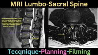 MRI Lumbo saccral spine technique plannning and filming tutorial [upl. by Per889]