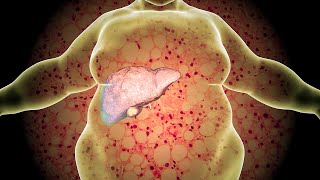 Domowe sposoby na stłuszczona wątrobę 11 naturalnych substancji [upl. by Anilak663]
