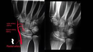 Scaphoid fracture  why knowing your anatomy is so important [upl. by Kati429]