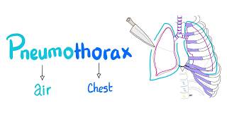 Pneumothorax  Spontaneous vs Tension Pneumothorax  Lung Physiology  Pulmonary Medicine [upl. by Marita]