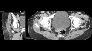 Trochanteric bursitis  CT findings [upl. by Adnoraj]