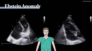 〖Echocardiography〗 Ebstein anomaly 💘 [upl. by Leizar480]