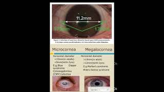 Normal Cornea VS Microcornea  Optometry Solutions [upl. by Osborne298]