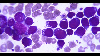 Burkitt Lymphoma [upl. by Moshe]