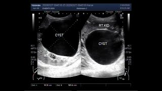 Ultrasound Video showing a large Renal Cyst [upl. by Primavera75]