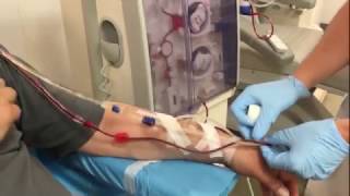 Dialysis connection of a patient with an arteriovenous fistula [upl. by Neetsuj151]